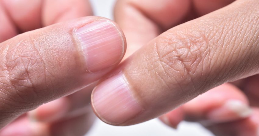 What Do Ridges On Fingernails Mean Nhs